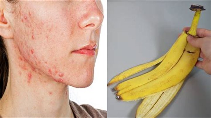 Does banana skin cure warts?