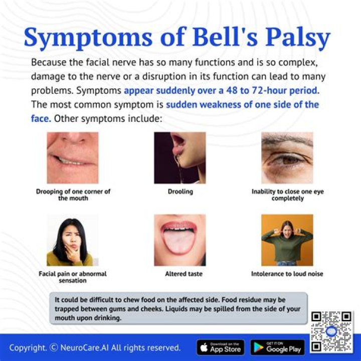 Does Bells Palsy affect breathing?