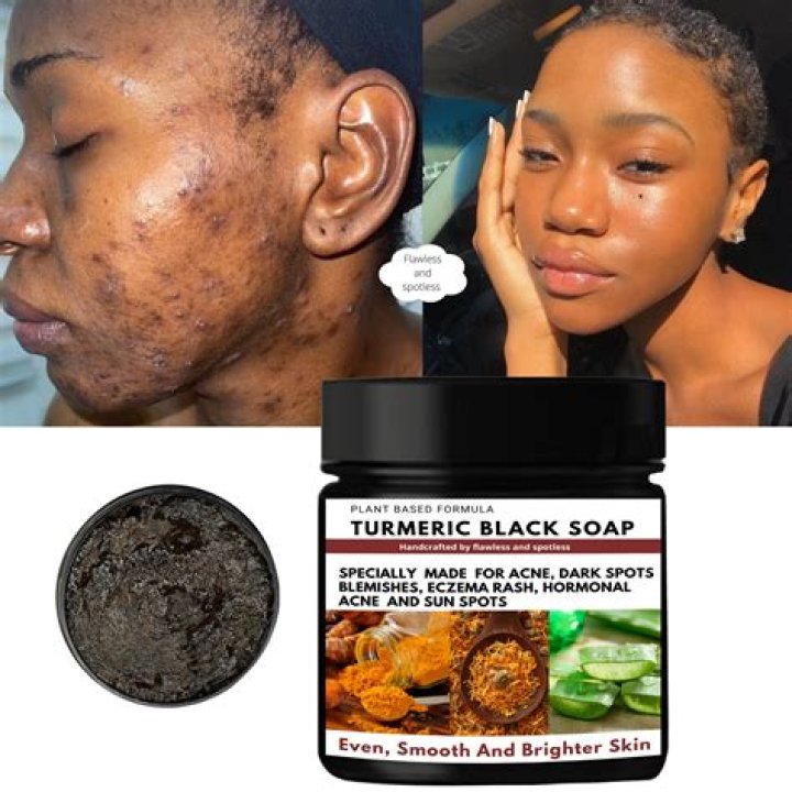 Does black soap remove dark spots?