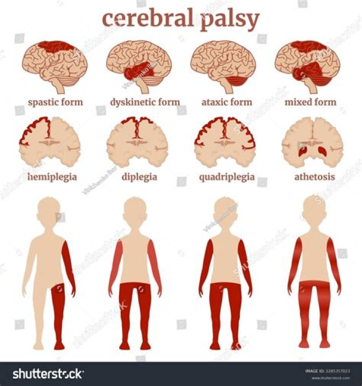 Does cerebral palsy qualify for SSDI?