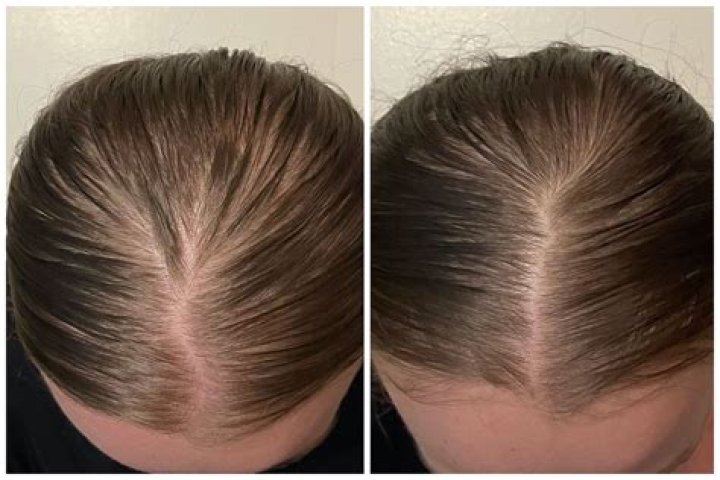Does collagen regrow hair?