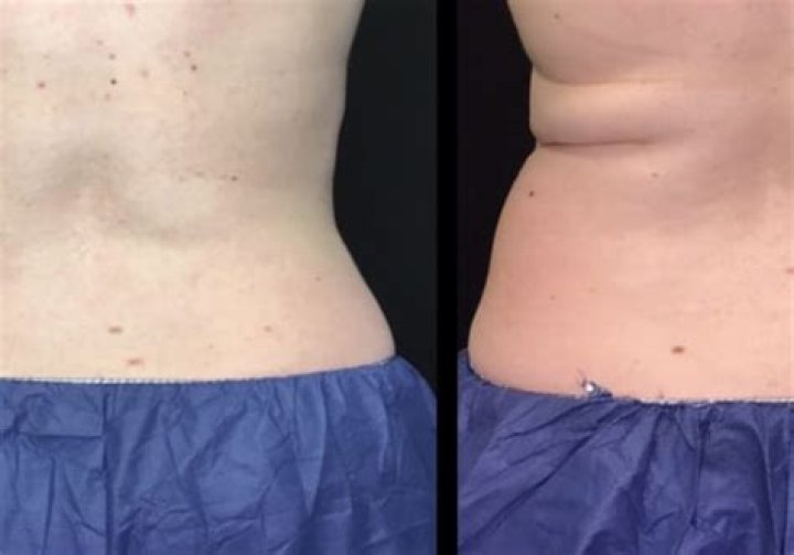 Does fat come back after CoolSculpting?