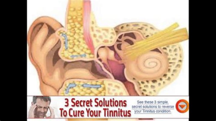 Does Medicare cover tinnitus treatment?
