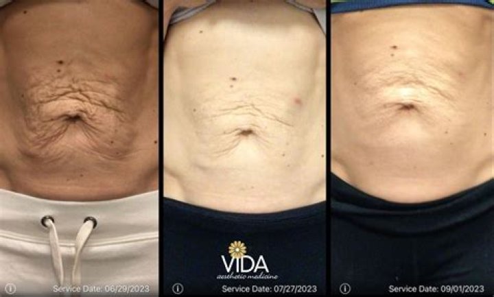 Does microneedling tighten stomach skin?