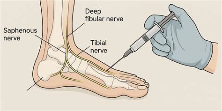 Does nerve flossing help neuropathy?