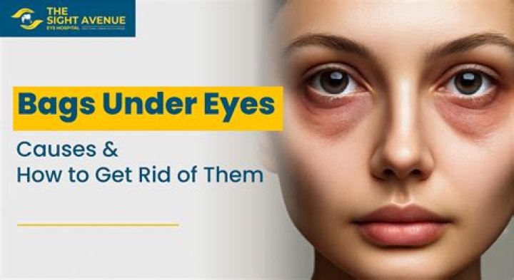 Does Retin-A help with bags under eyes?