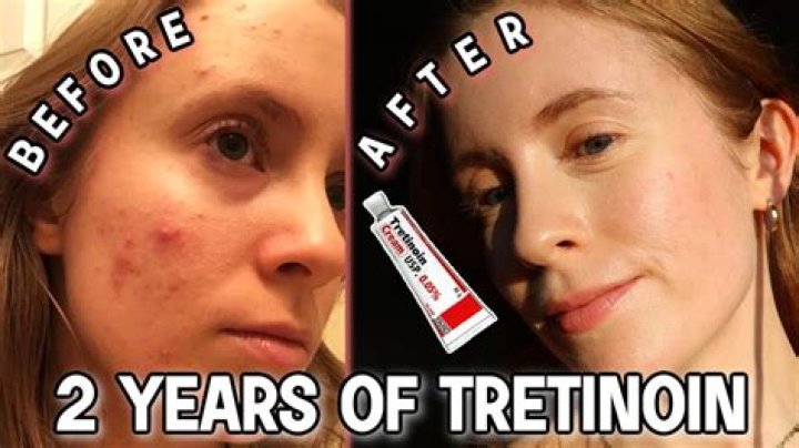 Does tretinoin work on old scars?