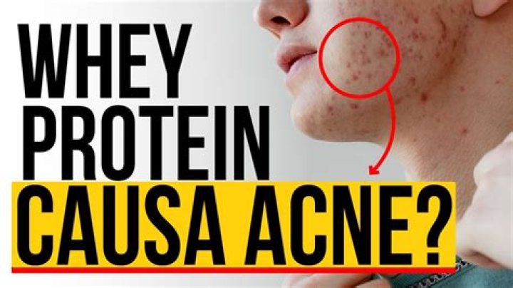 Does whey cause acne?