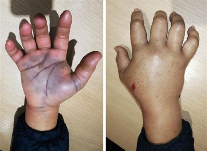 How bad is a hand contusion?