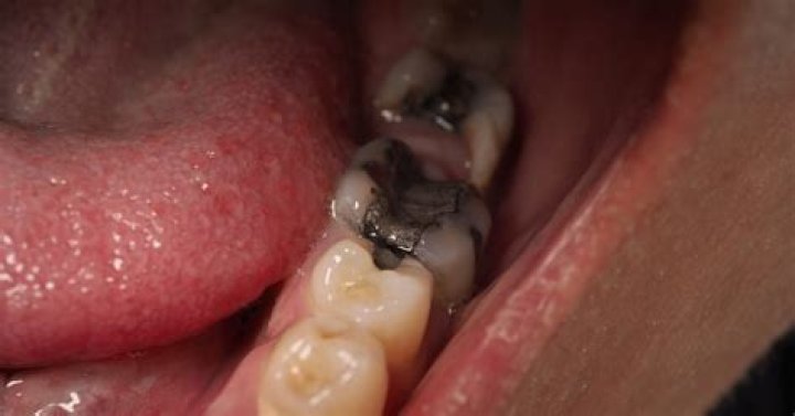 How can I cover a black tooth?
