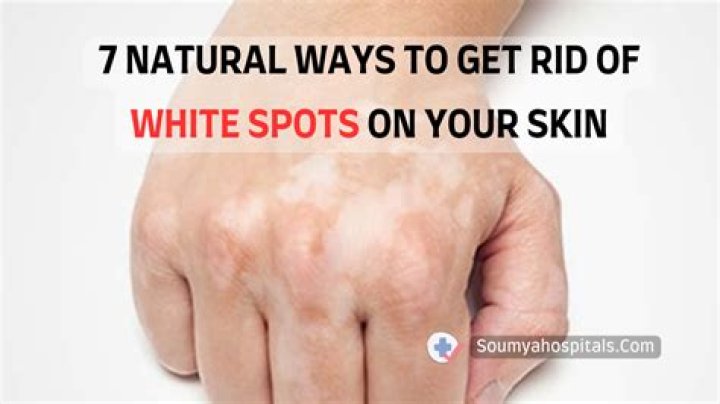 How can I get rid of white spots on my skin naturally?