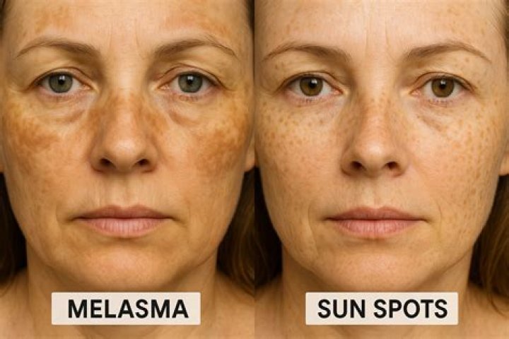How can you tell the difference between freckles and sun damage?