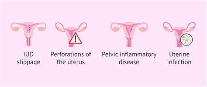 How common is IUD infection?