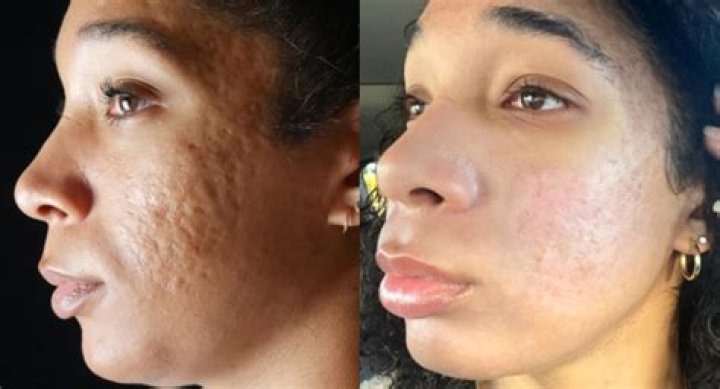 How do black people clear acne?
