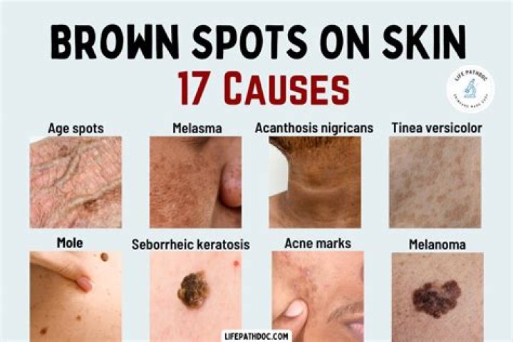 How do I get rid of brown scaly spots on my skin?