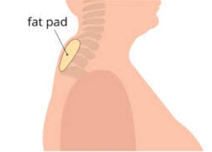 How do I get rid of Dorsocervical fat pad?