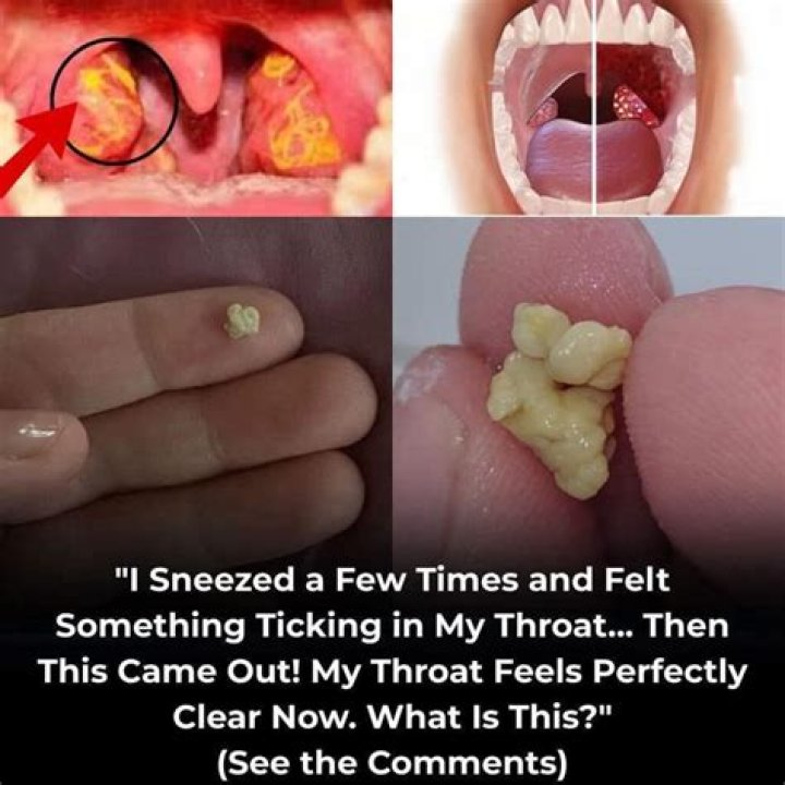 How do I get rid of the little smelly balls in my throat?