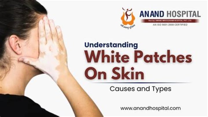 How do I get rid of white patches on my skin?