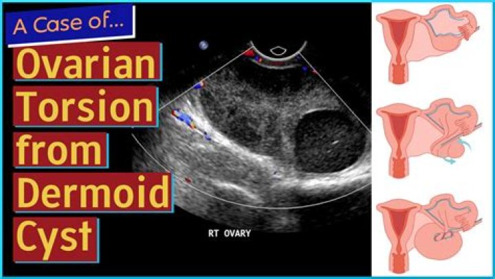 How do I know if I have a cyst on my ovary?