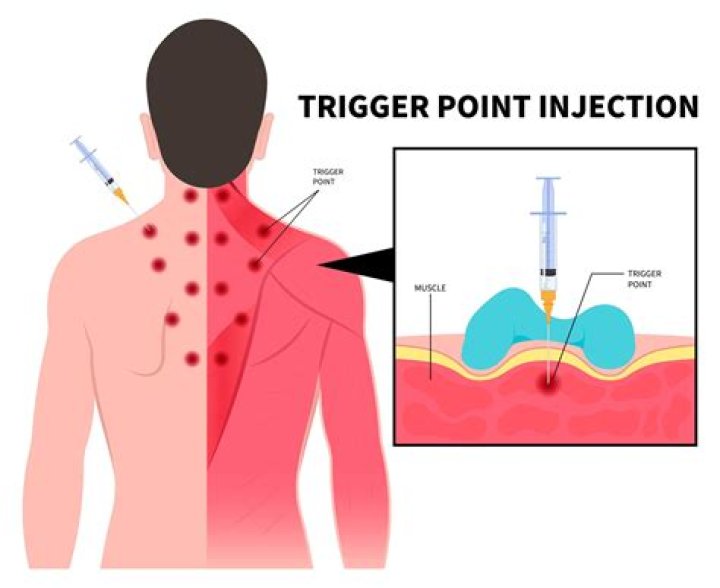 How do you break up a trigger point?