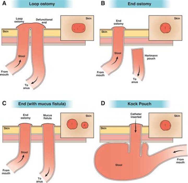 How do you clear a stoma blockage?