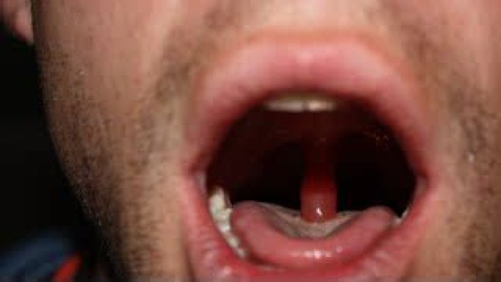 How do you get rid of uvulitis?