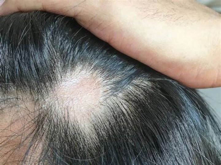 How do you know if your hair follicles are scarred?