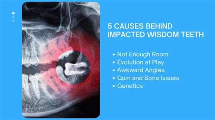 How do you know if your wisdom teeth need to come out?