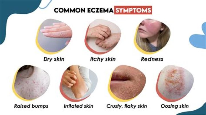 How do you know you have eczema?