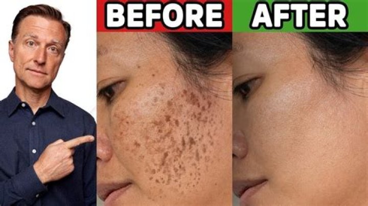 How do you reverse hyperpigmentation?