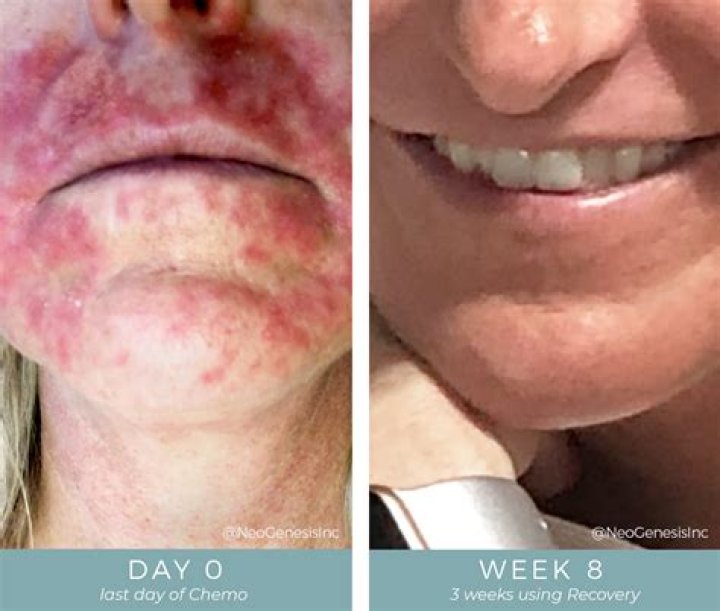 How do you treat chemo weakness?