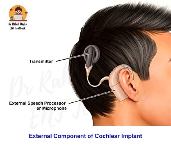 How does a cochlear implant stay in place?