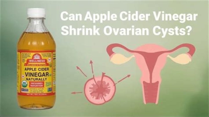 How does apple cider vinegar help ovarian cysts?