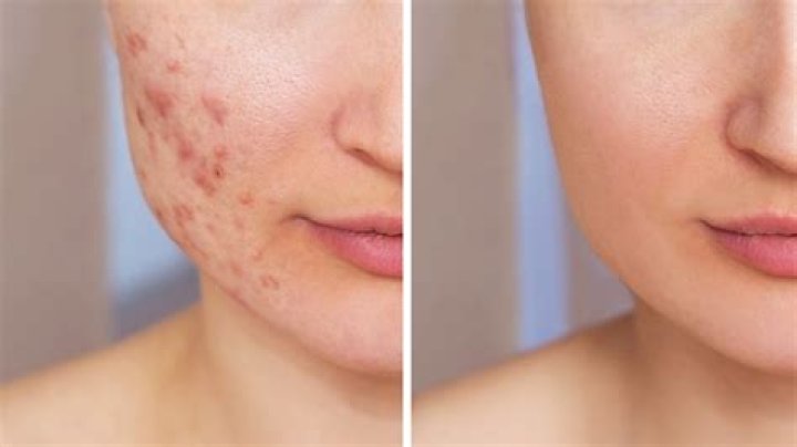 How does vitamin E help dark spots?