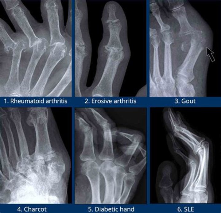 How long can rheumatoid arthritis go untreated?