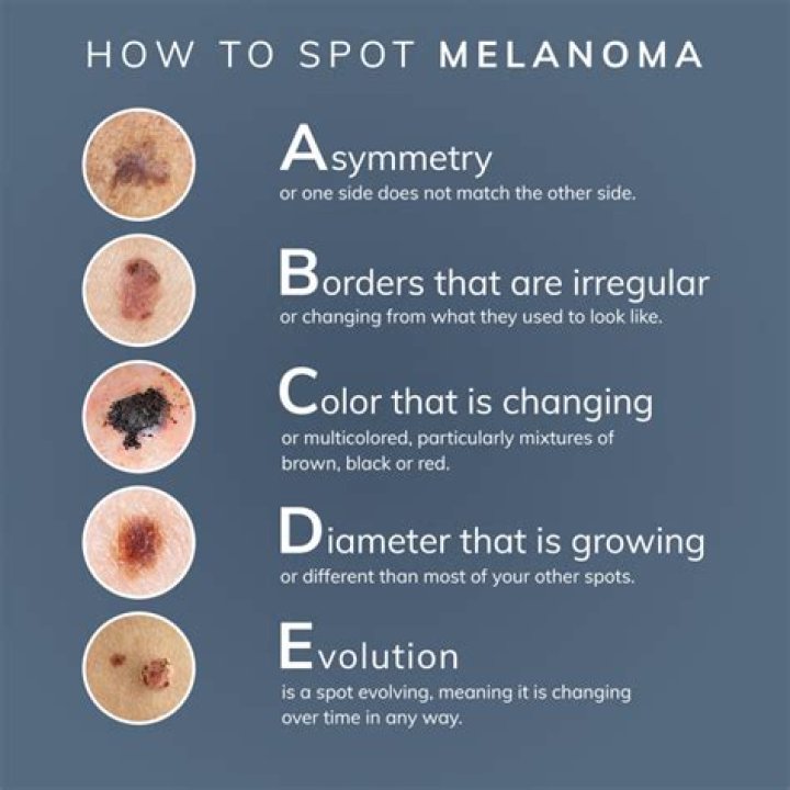 How long can you have melanoma without knowing?