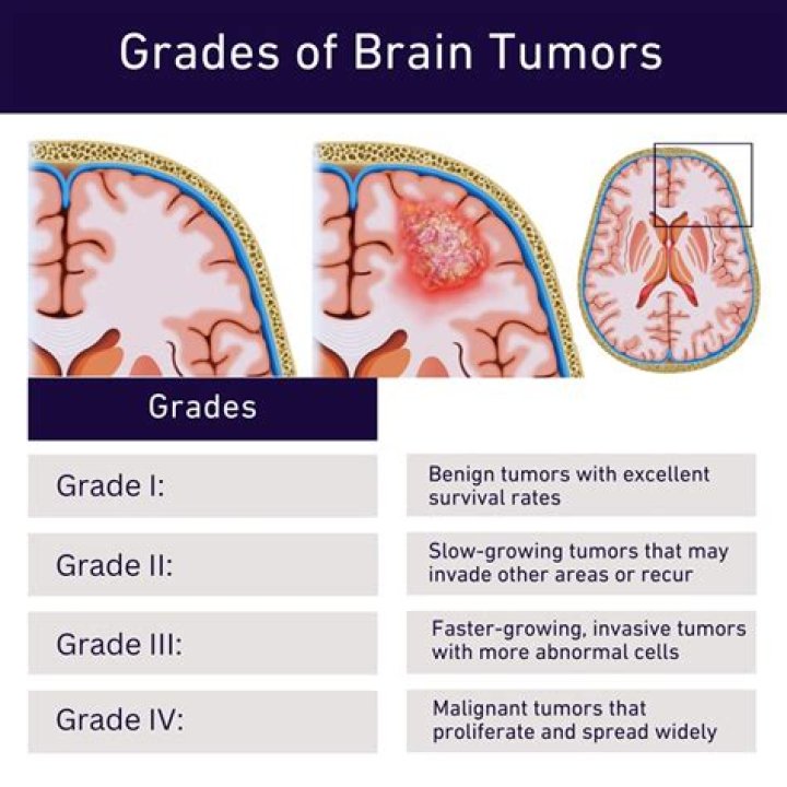 How long can you live with a grade 3 brain tumor?