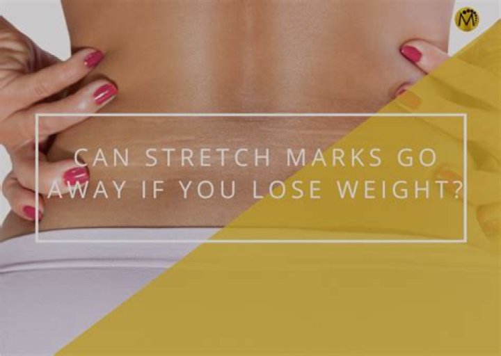 How long do stretch marks take to go white?
