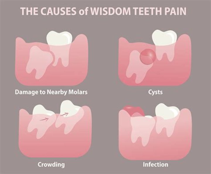 How long do wisdom teeth hurt?