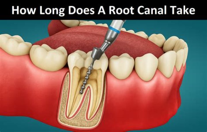 How long does a root canal take for one tooth?