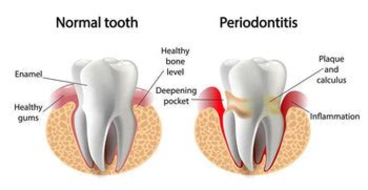 How long does gingivitis take to turn into periodontitis?