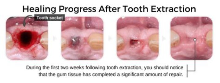 How long does it take for a molar extraction to heal?
