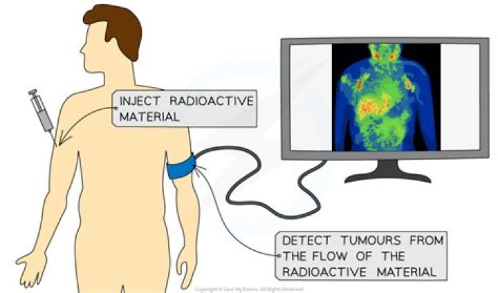 How long does it take for radioactive dye to leave your system?