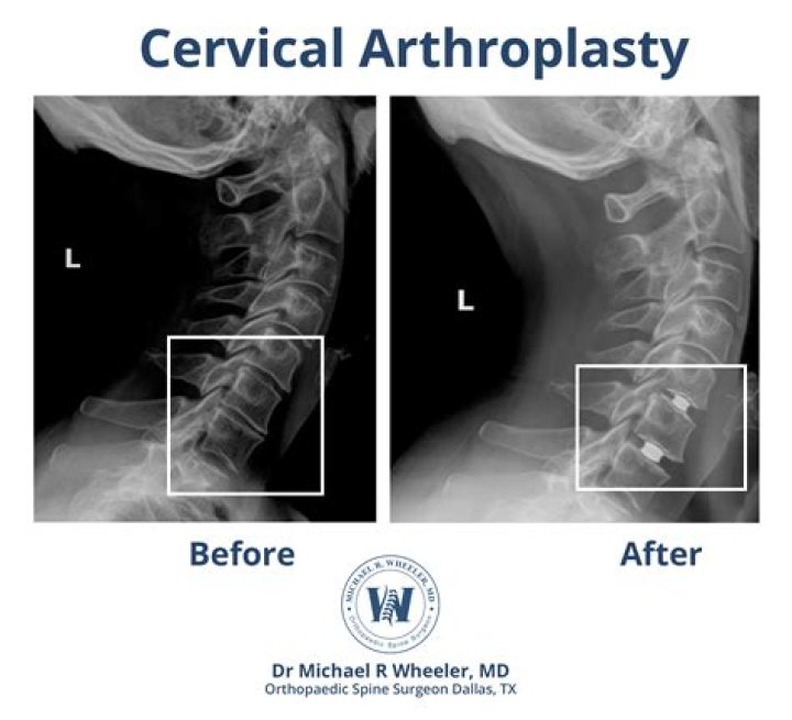 How long does pain last after port put in?