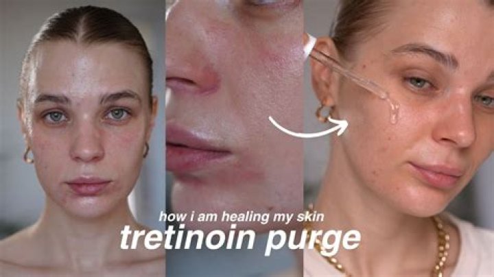 How long does the retinol purge last?
