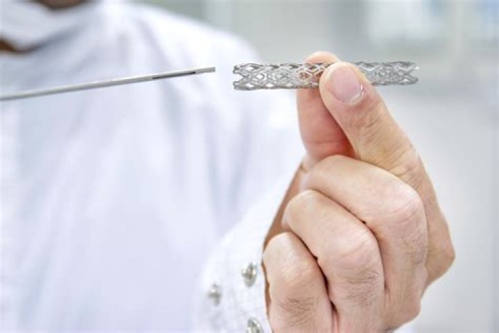 How long will a stent last?