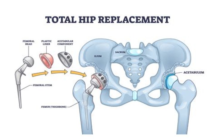 How many times can you have a hip replaced?