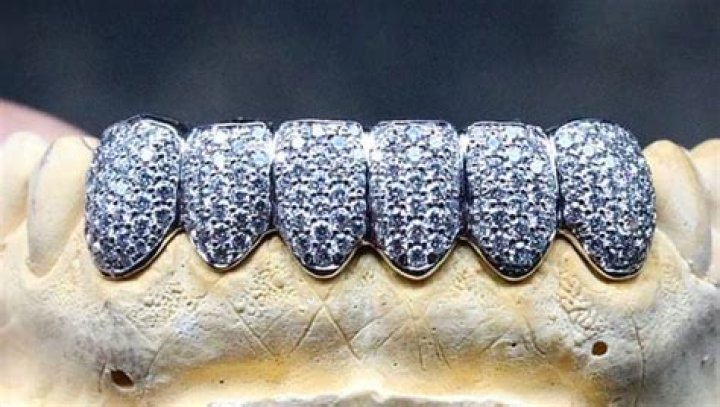 How much did Lil Wayne teeth cost?