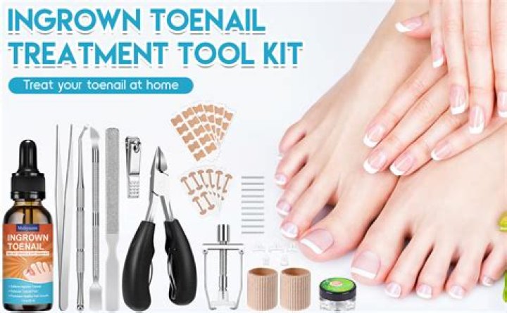 How much does it cost to have a ingrown toenail removed?