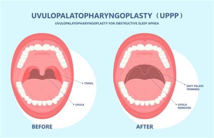 How much does it cost to remove uvula?